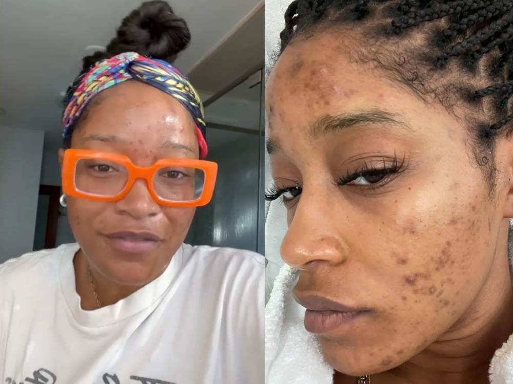 Deretan Selebriti yang Berbagi Pengalaman dan Perjuangannya Atasi Jerawat