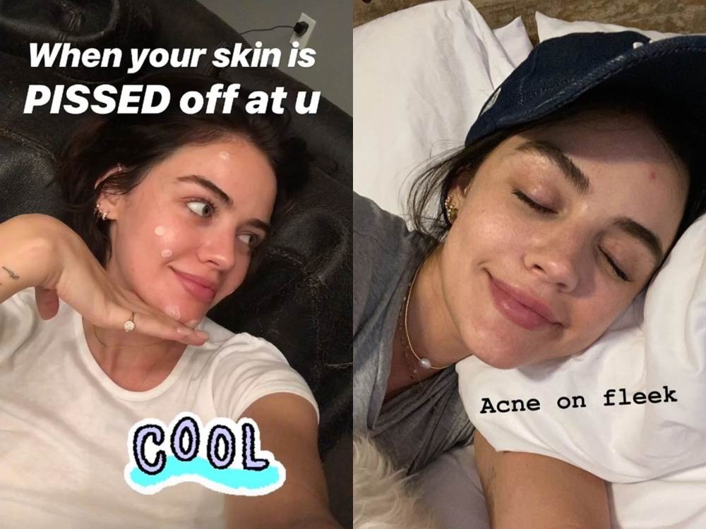 Deretan Selebriti yang Berbagi Pengalaman dan Perjuangannya Atasi Jerawat