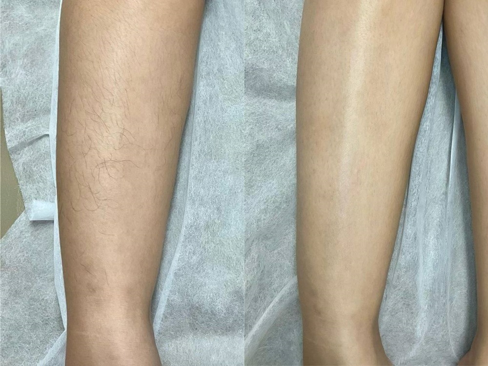 review-photo-facial-acne-treatment-di-zap-premiere-yogyakarta