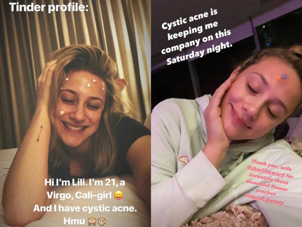 Deretan Selebriti yang Berbagi Pengalaman dan Perjuangannya Atasi Jerawat