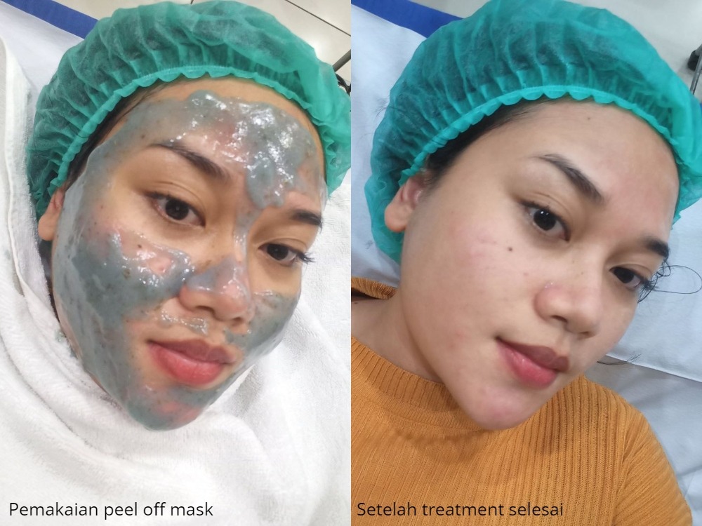 Facial Treatment di Klinik Estetika dr Affandi