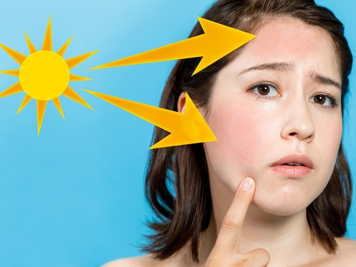 perbedaan-sunburn-dengan-sun-poisoning