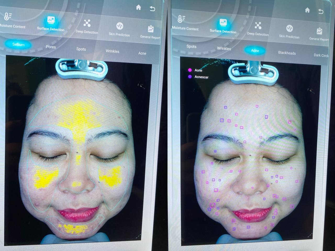 review-treatment-untuk-jerawat-and-hair-spa-superglow-clinic