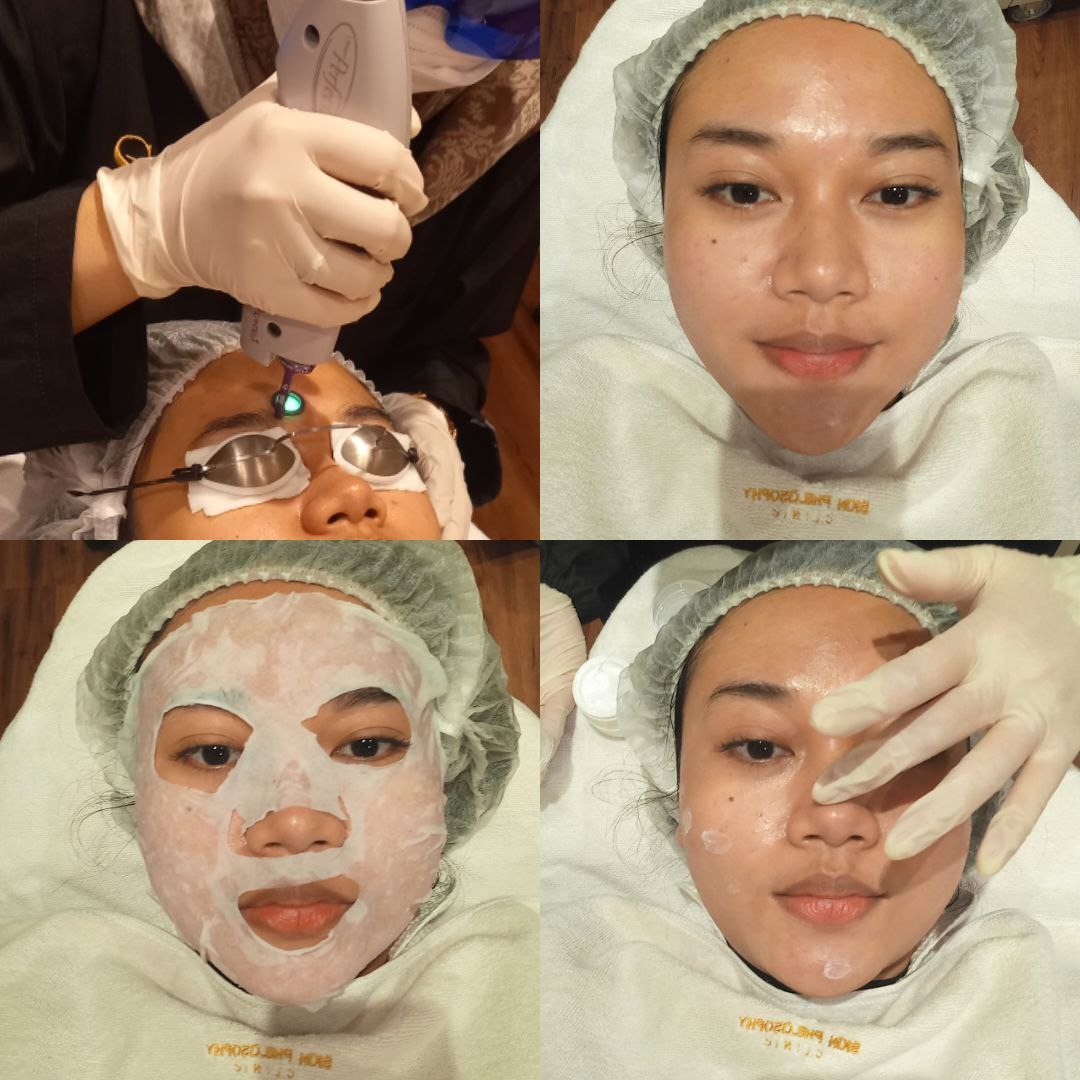 Pengalaman Treatment di Skin Philosophy Clinic