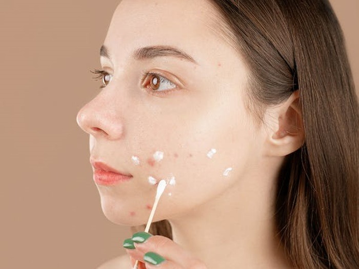 cara-menghilangkan-ice-pick-scars