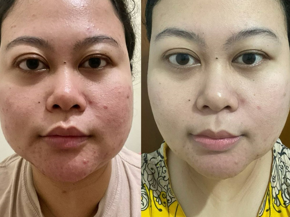 review-treatment-klinik-kecantikan-di-yogyakarta-superglow-clinic