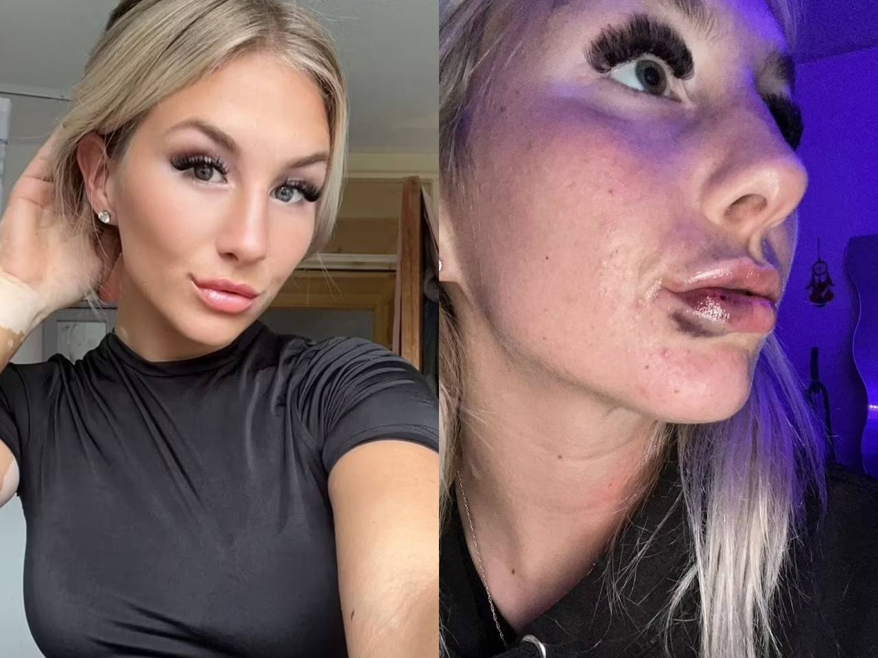 waspada-tindakan-lip-filler-murah