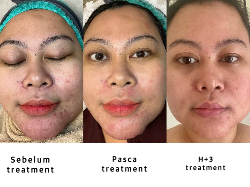 review-photo-facial-acne-treatment-di-zap-premiere-yogyakarta