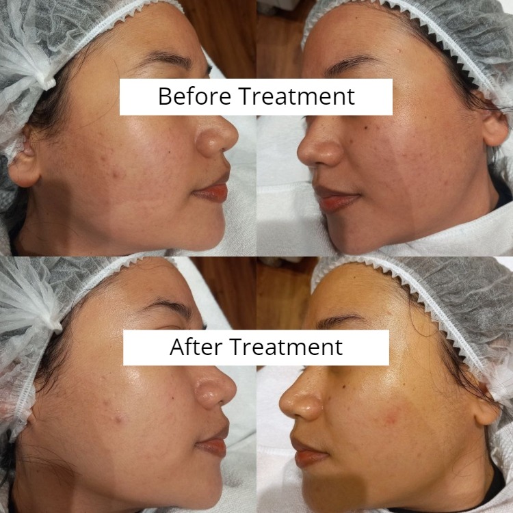 Pengalaman Treatment di Skin Philosophy  Clinic