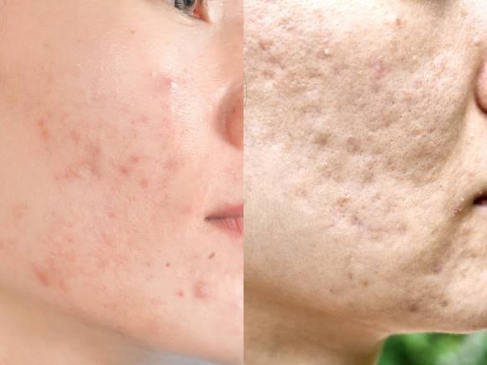 perbedaan-bekas-jerawat-acne-marks-and-acne-scars