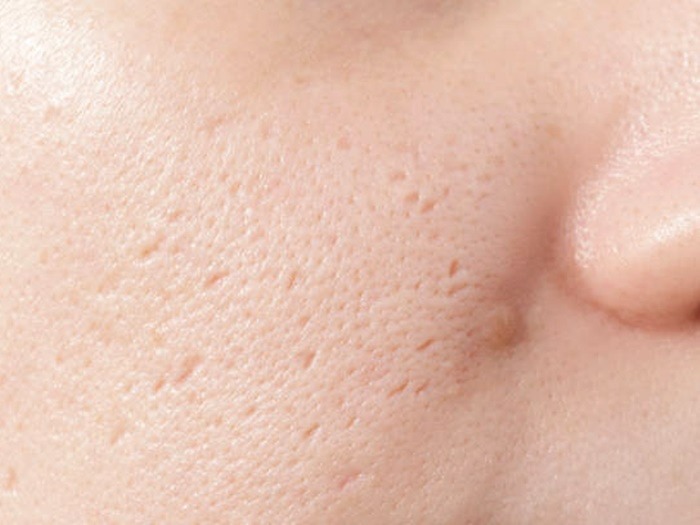 cara-menghilangkan-ice-pick-scars