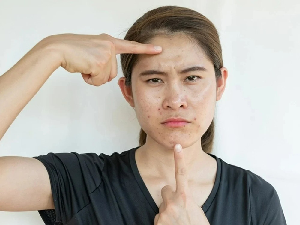 cara-mengatasi-jerawat-di-area-segitiga-berbahaya-pada-wajah