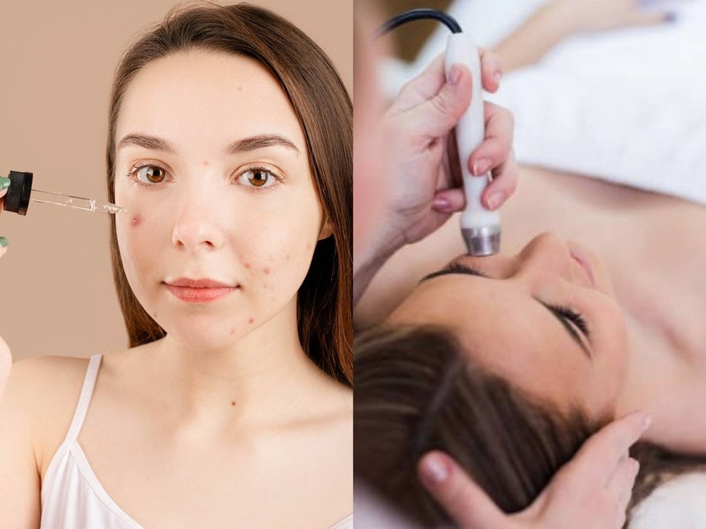 perbedaan-bekas-jerawat-acne-marks-and-acne-scars