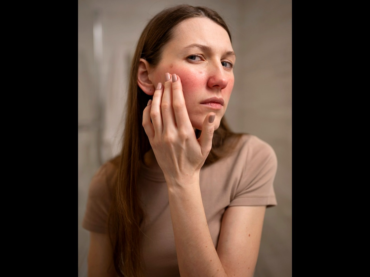 Rutinitas Skincare untuk Bantu Merawat & Menjaga Kondisi Kulit Rosacea