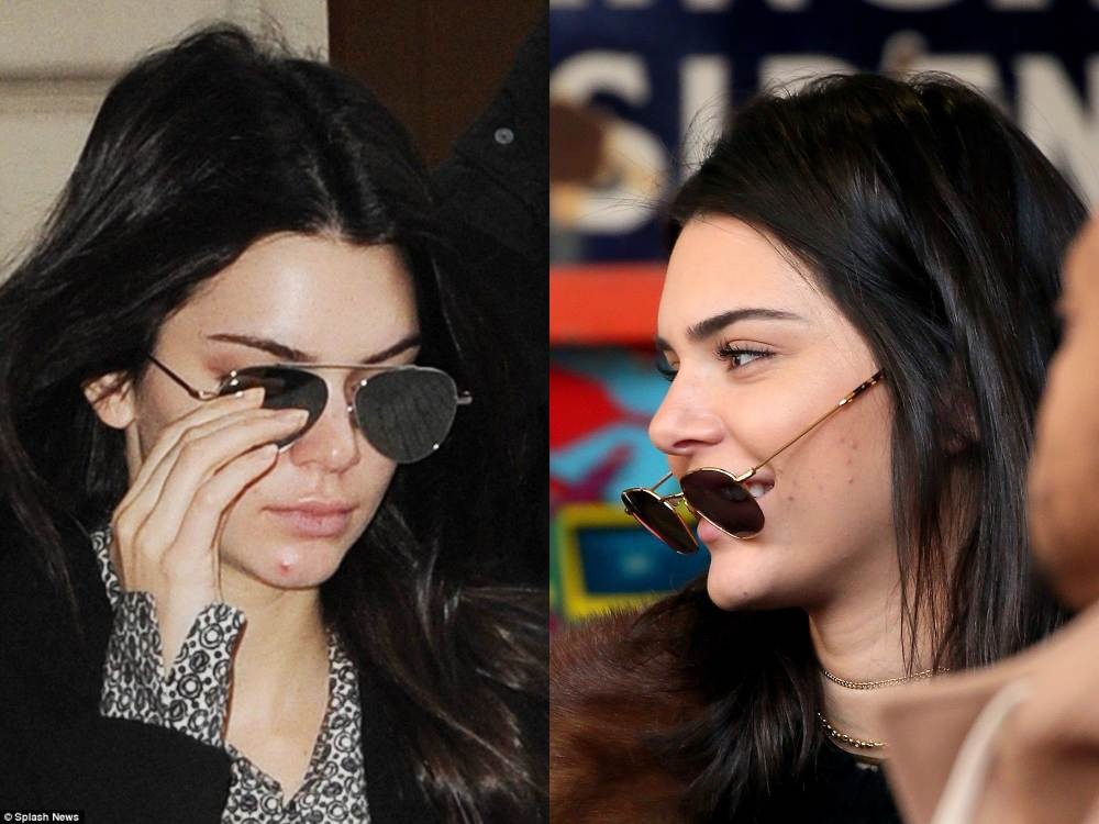 Deretan Selebriti yang Berbagi Pengalaman dan Perjuangannya Atasi Jerawat