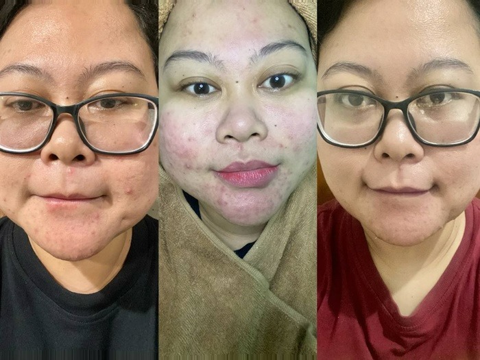 review-treatment-untuk-jerawat-and-hair-spa-superglow-clinic