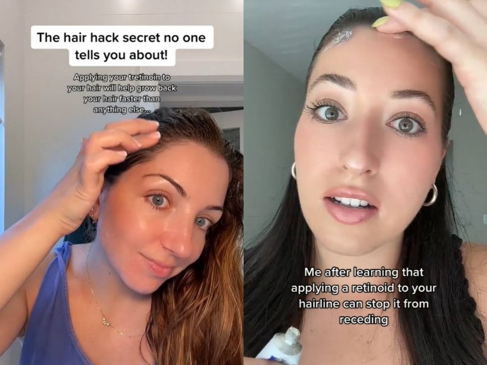 pendapat-ahli-mengenai-tretionoin-untuk-mengatasi-rambut-rontok