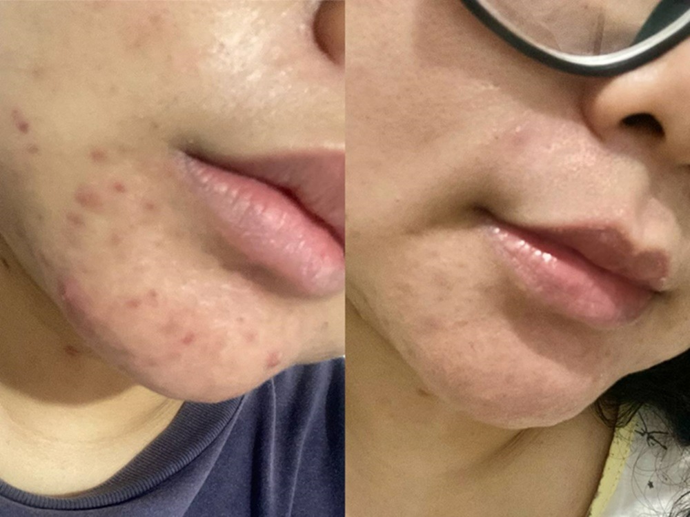 review-nama-beauty-acne-series-cleansing-gel-dan-serum-jerawat