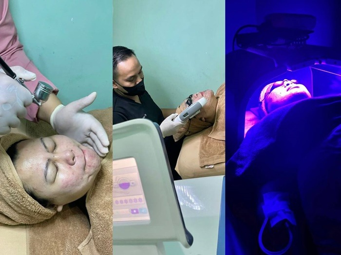 review-treatment-untuk-jerawat-and-hair-spa-superglow-clinic